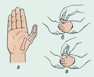 как лечить вывих большого пальца руки в домашних условиях