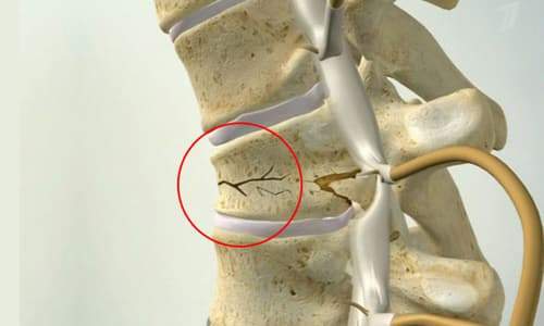 как можно лежать при компрессионном переломе позвоночника
