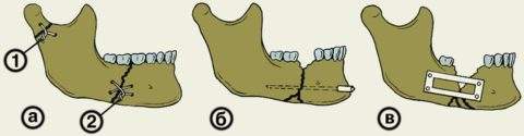 как накладывают шину при переломе нижней челюсти