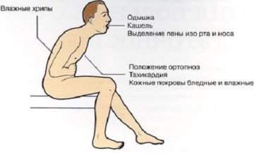 как отличить кардиогенный отек от некардиогенного отека легких