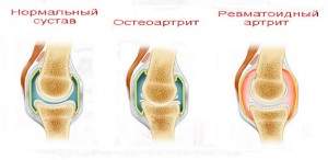 как снять отек и боль в суставе руки