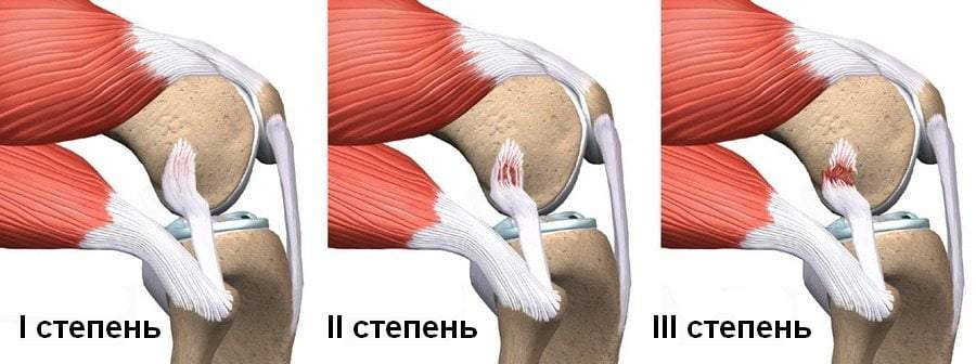 как снять отек коленного сустава после растяжения связок