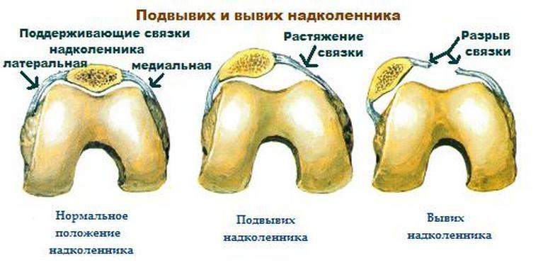 как снять отек коленного сустава после растяжения связок