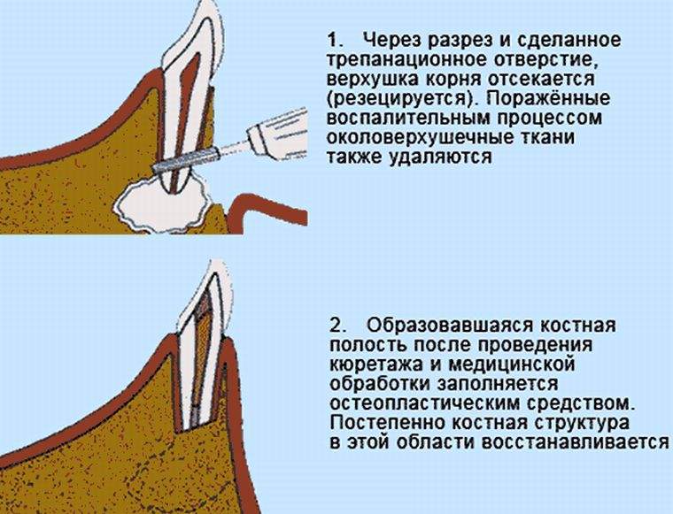 как снять отек после резекции верхушки корня зуба