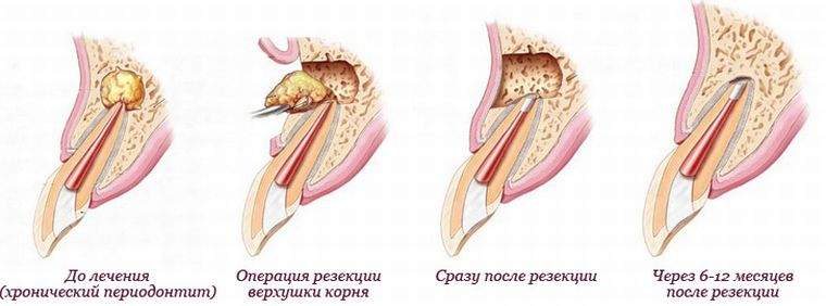 как снять отек после резекции верхушки корня зуба