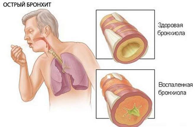 как снять отек слизистой бронхов травами при астме