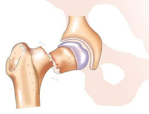 как уберечь себя от перелома шейки бедра