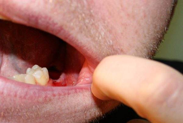 какие антибиотики принимать при отеке после удаления зуба
