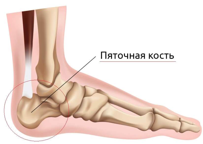 какие признаки перелома или трещины на пятки