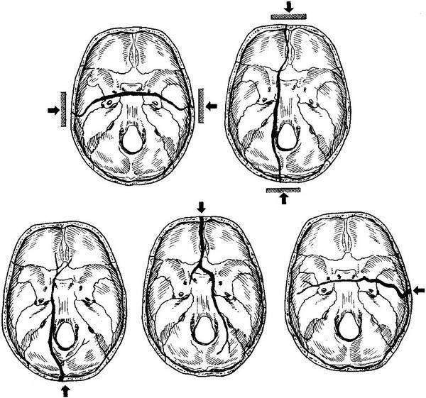 какие симптомы наблюдаются при переломе костей черепа