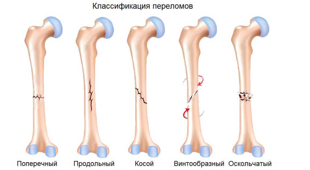 какие симптомы при переломе руки у ребенка