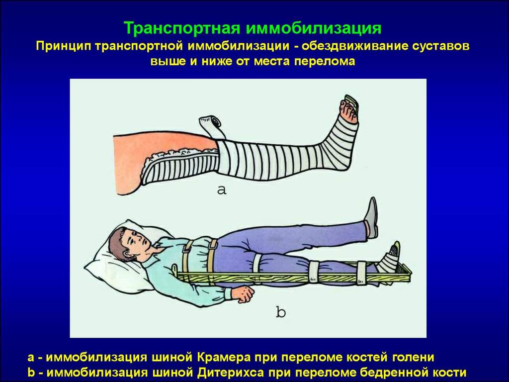 какие суставы должна фиксировать шина при переломе