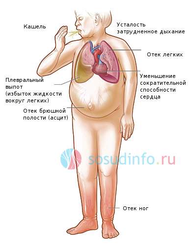 кардиогенный отек легких первая помощь и неотложная терапия