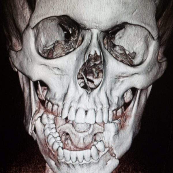 классификация неогнестрельных переломов нижней челюсти по энтину