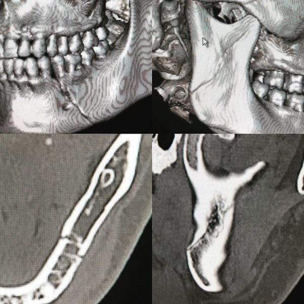 классификация неогнестрельных переломов нижней челюсти по энтину