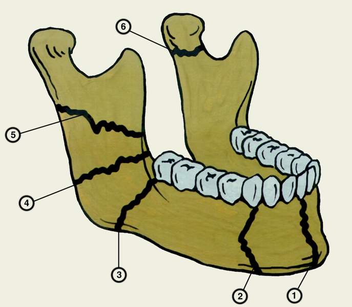 классификация переломов нижней челюсти с дефектом кости