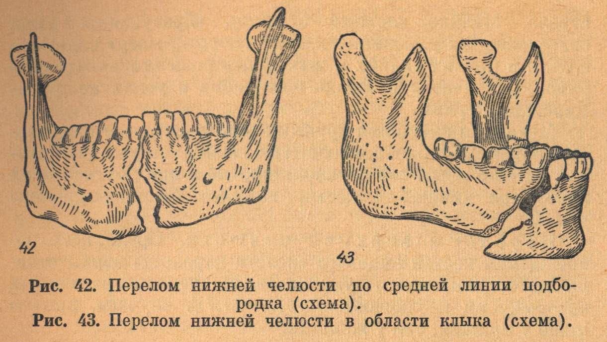 Клиническая картина при переломах нижней челюсти