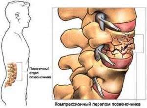 клиническим признаком компрессионного перелома тела позвонка считается