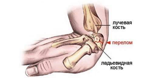 когда можно отжиматься после перелома лучевой кости