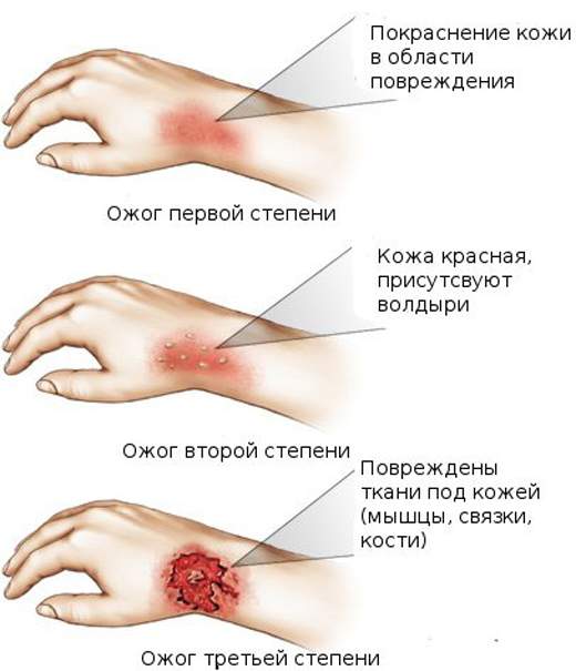 когда проводят реанимацию при переломе при кровотечении