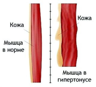 комплекс упражнений для восстановления после перелома бедра