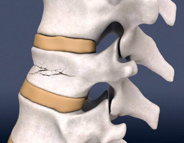компрессионный перелом позвоночника грудного отдела лечение дома