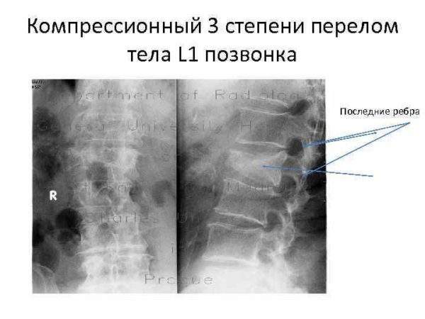 компрессионный перелом позвоночника поясничного отдела лечение последствия