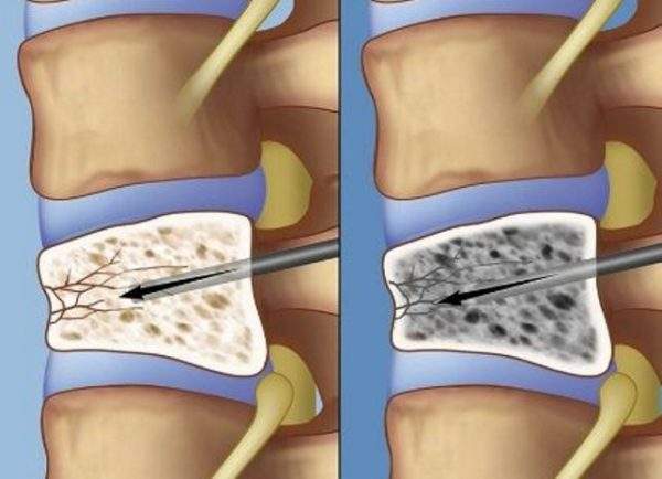компрессионный перелом позвоночника поясничного отдела лечение последствия