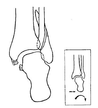 косой перелом латеральной лодыжки с небольшим смещением
