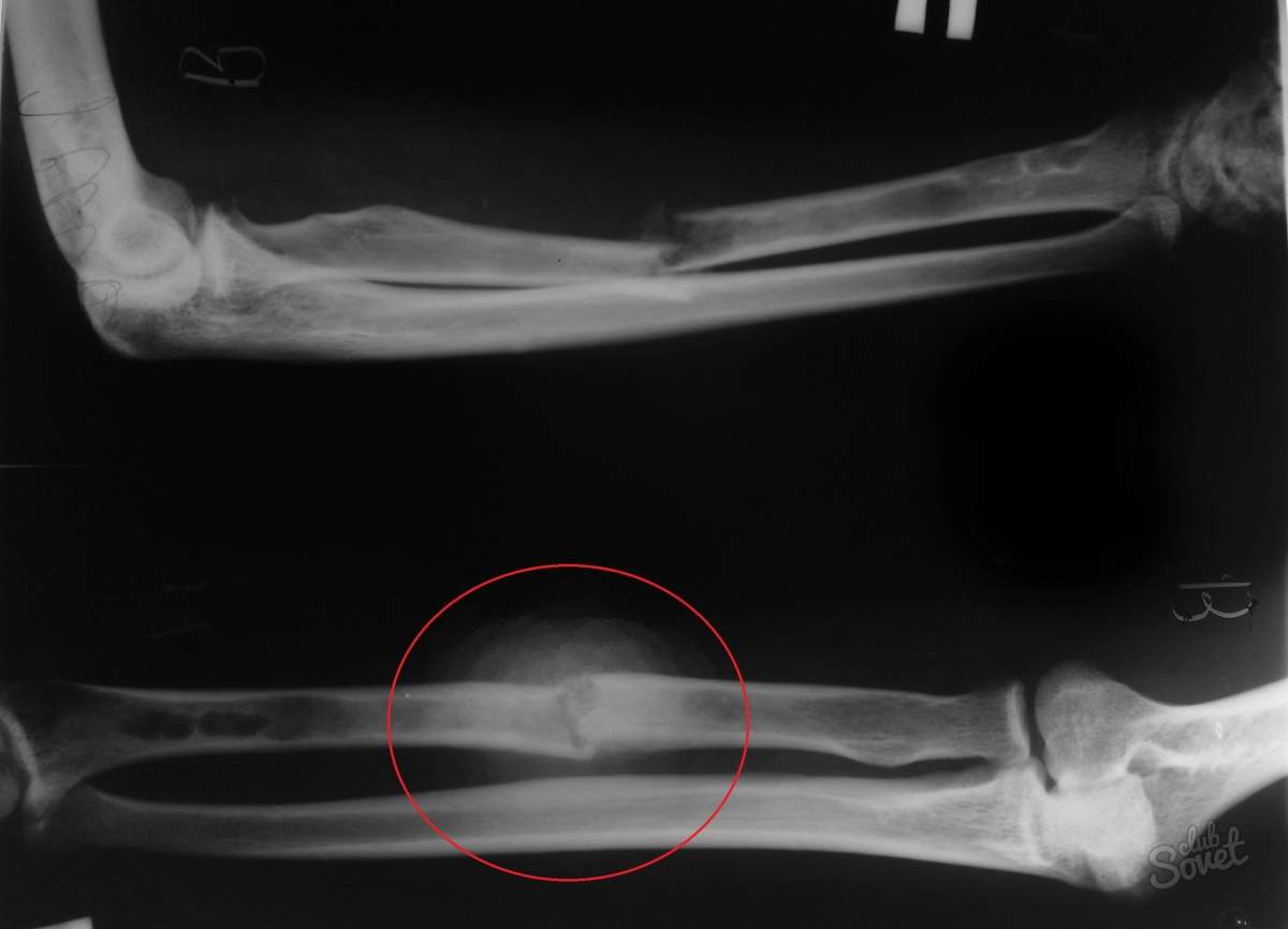 костная мозоль после перелома руки когда рассасывается