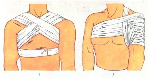крестообразная повязка на плечевые суставы при переломе