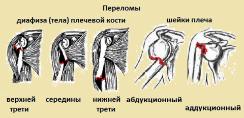 лечебная гимнастика для плечевого сустава после перелома