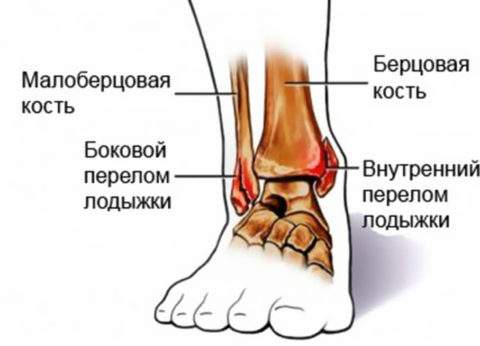 лечебная гимнастика после перелома голени со смещением