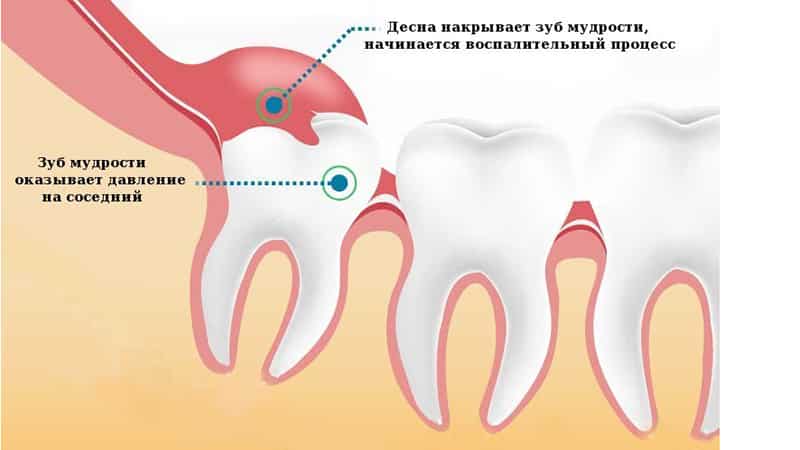 лезет зуб мудрости опухла щека как снять отек