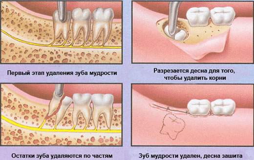 лезет зуб мудрости опухла щека как снять отек