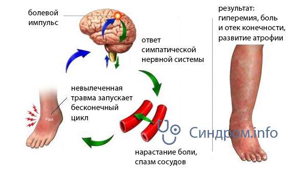 лфк при переломе запястья руки синдром зудека