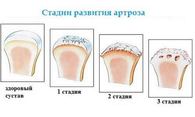 массаж при переломе лучезапястного сустава со смещением