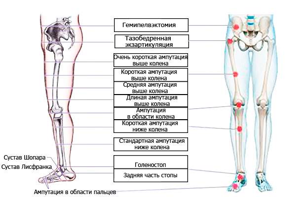могут ли из за перелома ампутировать ногу