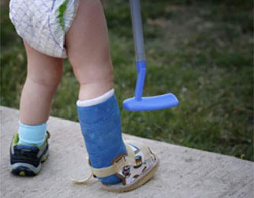 может ли ребенок ходить с переломом ноги
