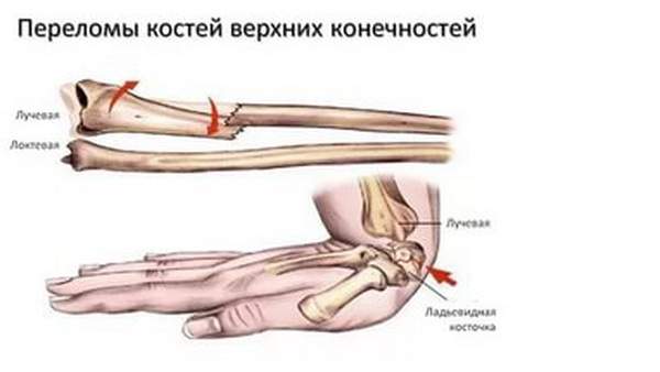 на предплечье наиболее часто подвергается перелому кость