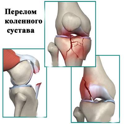 на сколько накладывают гипс при переломе колена