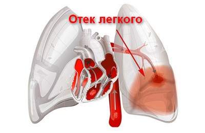 неотложная помощь при инфаркте миокарда осложненном отеком легких