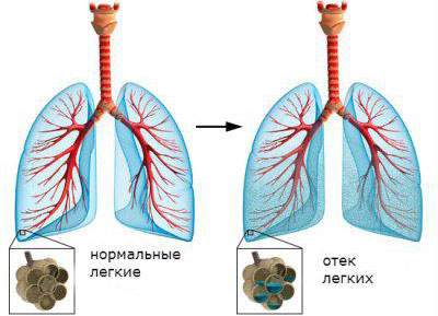 неотложная помощь при отеке легких алгоритм действий медсестры