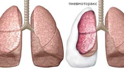 неотложная помощь при отеке легких алгоритм действий медсестры