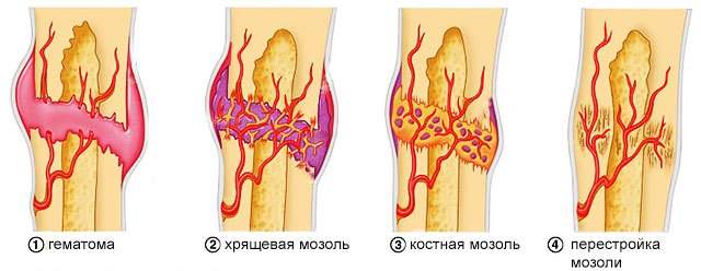 образование костной мозоли при заживлении перелома осуществляет