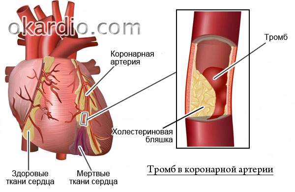 обширный инфаркт с отеком легких последствия шансы выжить