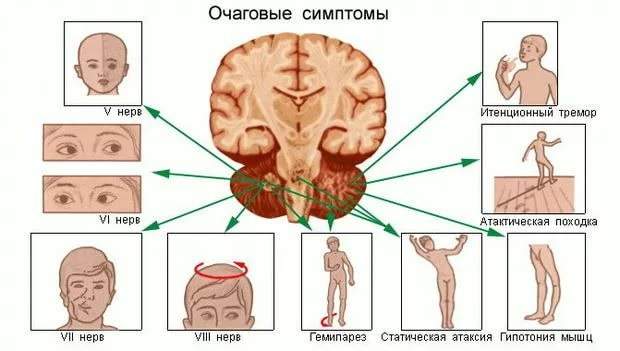 очаговая неврологическая симптоматика при ушибе головного мозга