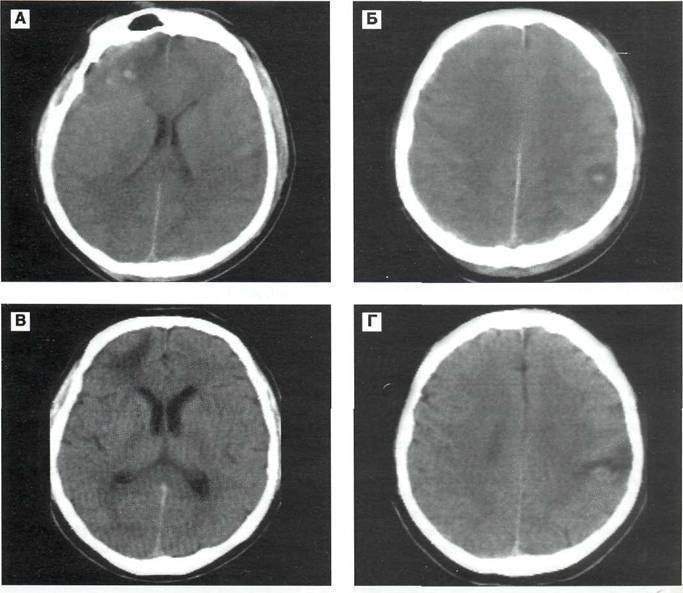 очаговые нарушения при ушибе головного мозга пример