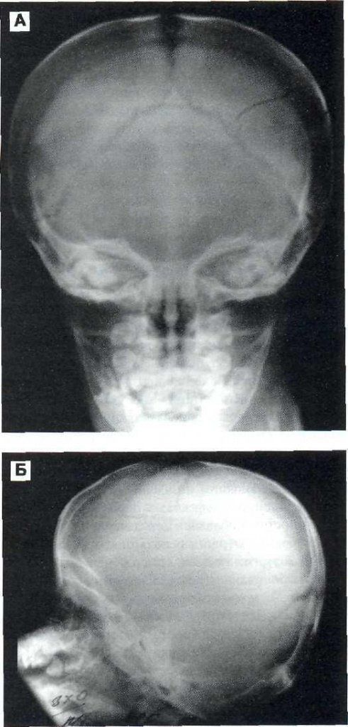 операции при вдавленных переломах черепа у детей