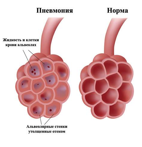 отек легких и пневмония это одно и тоже